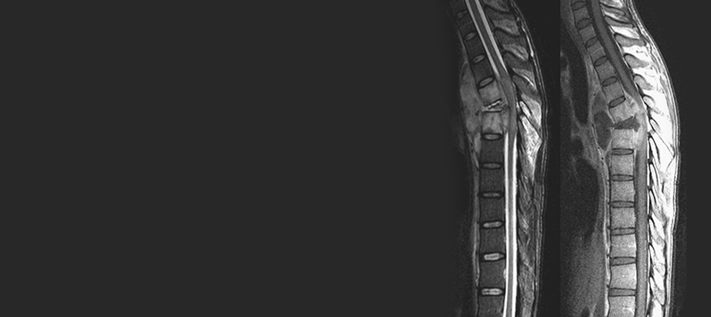 Spinal Tuberculosis: Symptoms and Treatment